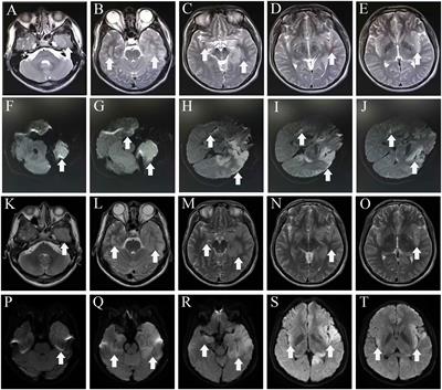 Case report: Overlapping anti-AMPAR encephalitis with anti-IgLON5 disease post herpes simplex virus encephalitis